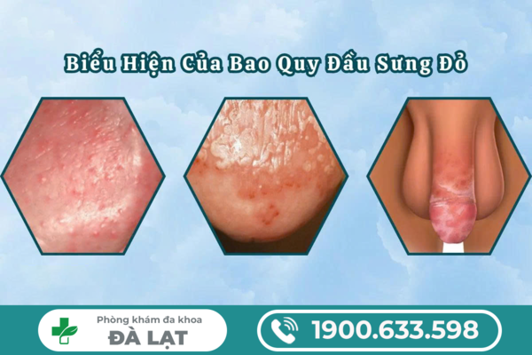 Hình ảnh minh họa